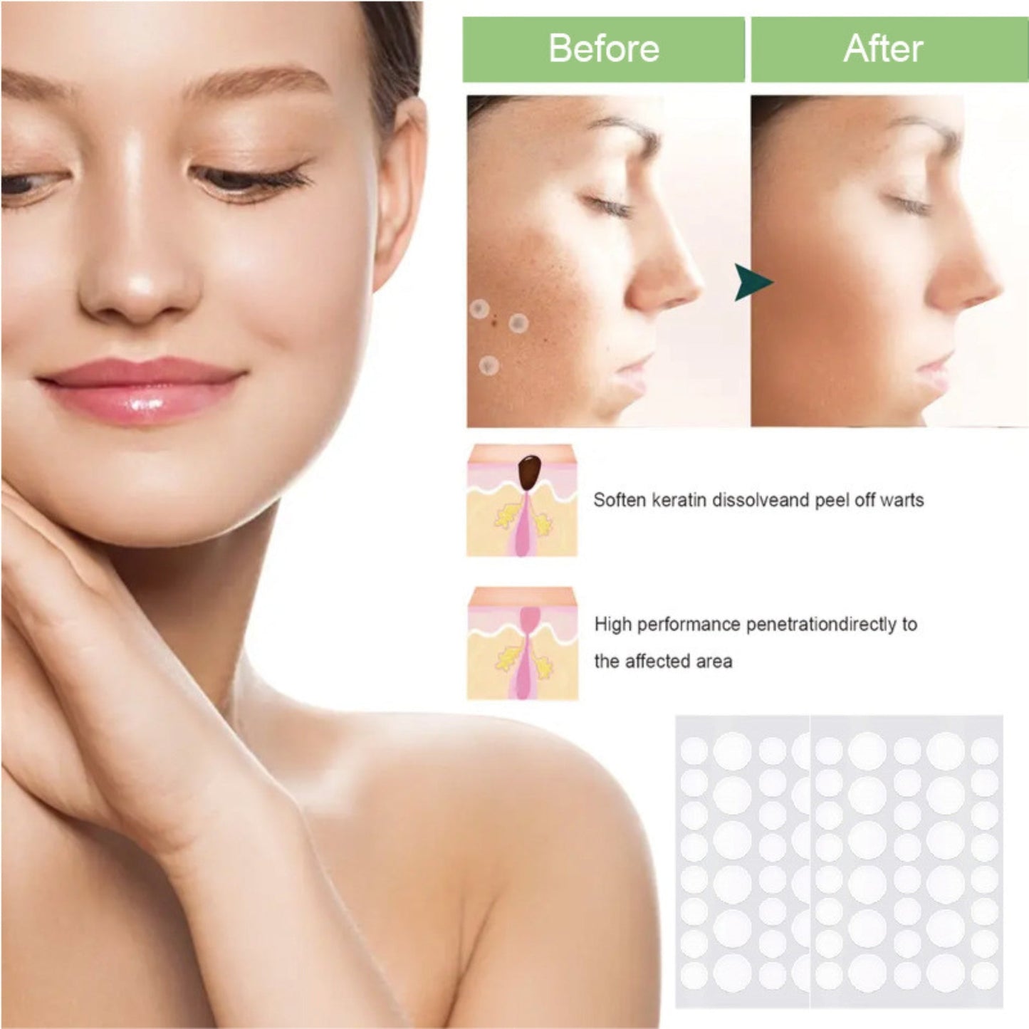 Anti-Acne Concealer Patch - Invisible Blemish Protection (72 Patches)